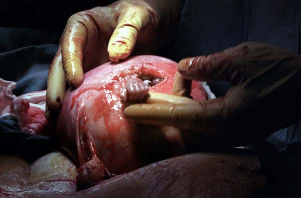 Samuel Alexander Armas, Spina Bifida Fetal Surgery Samuel Alexander Armas, Spina Bifida Fetal Surgery