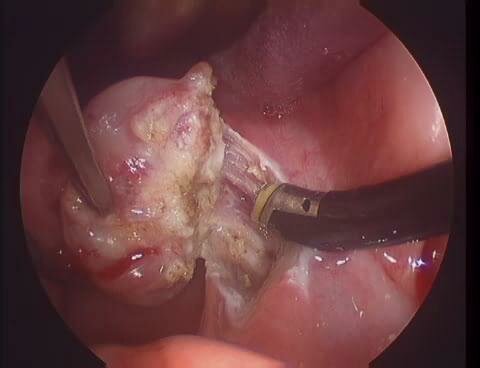 Tonsillectomy by Coblation